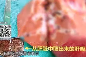 幼儿吃三文鱼结果出问题，去体检竟查出肝吸虫，家属不敢相信视频封面