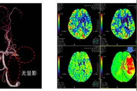 老人一觉醒来手脚动不了，医生从血管里抽出一条长长的血栓图片