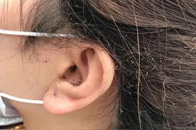 女子美容院拔火罐，身体竟直接烧了起来，检查时老板却跑了？图片