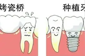 口腔科专家带您认识人类的“第三副牙齿”——种植牙图片
