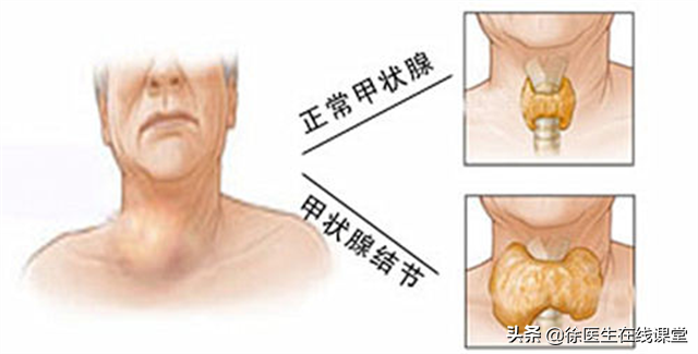 甲状腺结节有什么忌口 2026年甲状腺结节10大忌口＂,＂no_ai_sug＂:true},{＂