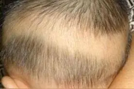 枕秃就是缺钙吗？图片