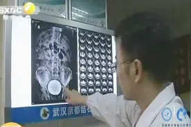 直径13公分！湖北男子膀胱长出巨型结石 与长期久坐憋尿有关视频封面