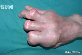 皮肤长出石头？六旬老伯长期吃海鲜手脚严重变形图片
