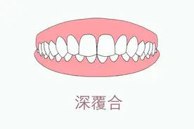 牙齿深覆合，应该矫正还是正颌？图片