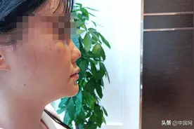 女子整形感染后变“朝天鼻”，此前曾做过5次手术图片