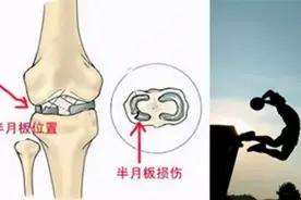 热爱运动的你，怎么就半月板损伤了？图片