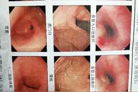 咽喉与食道粘膜烧灼与双氧水有关图片