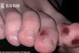 警惕！西班牙专家：脚趾起痘或为新冠病毒早期症状图片