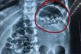 2岁女童误食“水宝宝”，险肠道破裂生命受威胁：别因疏忽酿大错图片