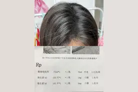 脱发还真得去医院看！花的少办放心的事图片