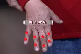 老寒腿、风湿反复发作，当心骨关节“减寿命”！养骨用3招通络活血图片