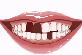 揭秘 |  种牙就像“拧螺丝钉”？种植牙到底是怎么“种”的？图片