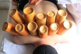 拔完火罐，身上出现的淤血印记，是什么？图片