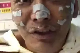 睡前没熄灭香薰蜡烛，说唱歌手在家深度烧伤图片