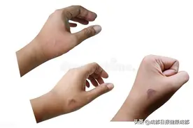 你身上的疤痕怎么办？烧伤整形外科医生巴心巴肝整理了这些答案图片
