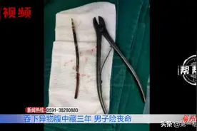 男子腹痛难忍，罪魁祸首竟是三年前吞下的一根笔芯？图片