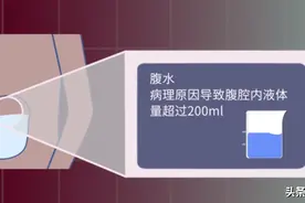 医生如何应对顽固性腹胀？先提防“先风后雨”再应战「腹水」难收图片