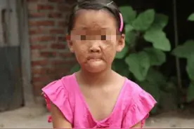 妈妈烧沸的一壶水，“夺走”了6岁女儿的脸，医生怒斥家长太无知图片