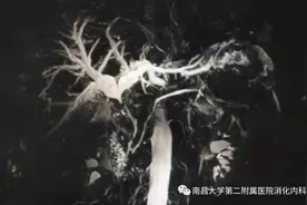 南大二附院消化内科红角洲院区胆胰团队完成一例毕II式胃大部切除术后高难度ERCP手术图片