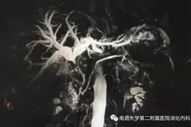南大二附院消化内科红角洲院区胆胰团队完成一例毕II式胃大部切除术后高难度ERCP手术图片