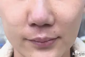 三万元做鼻综合“有点歪”，患者质疑效果差图片