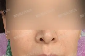 拉皮手术亲身经历图，来看看56岁姐姐做拉皮手术的亲身经历图片