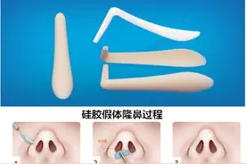 如何选择隆鼻材料，看这篇就够了图片
