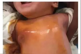 还在给新生儿挤乳头？这种糟糕习俗危害大到抱憾终身图片