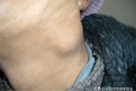 肺外结核——颈淋巴结结核图片
