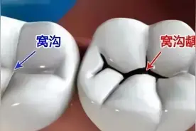 您的孩子是否需要做窝沟封闭？何时做窝沟封闭合适？图片