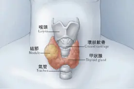 体检时查出的甲状腺结节钙化，到底是什么？图片