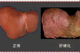 男人最尴尬的病——男性乳房发育！你知道它的病因是什么吗？图片