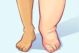 双下肢水肿？医生：你可能正在吃这些药物图片