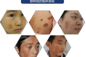 咖啡斑还有什么危害吗？图片