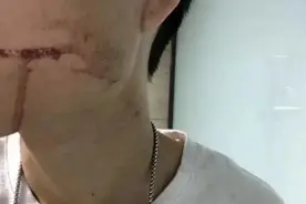 小伙拔完智齿流血不止死亡，口腔医生告诉你，白血病千万别拔牙图片