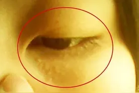 眼角脂肪粒别急着挤，教你1招，轻松去除不留痕，不疼不痒效果好图片