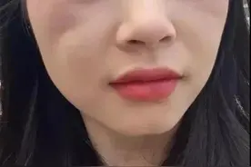 让你显老十岁的印第安纹，该怎么去除？图片