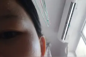 天哪？使用壬二酸和甲硝唑凝胶第三天～我皮肤感觉更差了图片