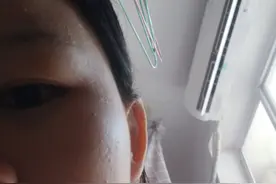 天哪？使用壬二酸和甲硝唑凝胶第三天～我皮肤感觉更差了图片
