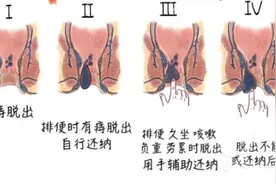 痔疮的最佳自愈方法图片