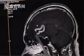 男子拔牙竟造成脑部感染发脓，拔牙的这些忠告，每个人都应该知道图片