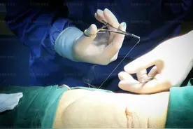 吸脂手术都有针眼，你若想伤口无痕，医生选择什么线缝合也很关键图片