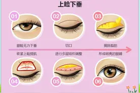 上睑下垂怎么办？常见的治疗方法有这些图片