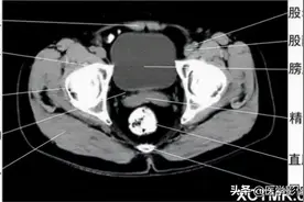 胸、腹、盆腔 CT断层解剖图片