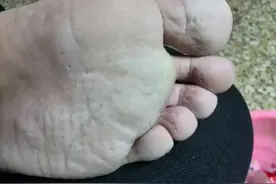 得了脚气怎么办？还能治好吗？图片