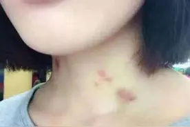 14岁女儿脖子出现草莓印，妈妈没急着问，仅用了一招女儿主动认错图片