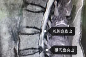 “腰椎间盘膨出”，是什么意思，严重吗图片