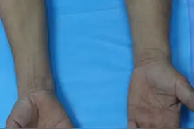 “爪型手”？竟是血管畸形惹的祸图片