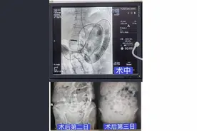 郴州一医微创介入诊疗拯救结肠癌术后肠梗阻患者：小小导管解决大问题图片
